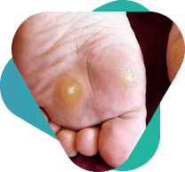 OLHO DE PEIXE, É ASSIM QUE A VERRUGA PLANTAR É CONHECIDA!